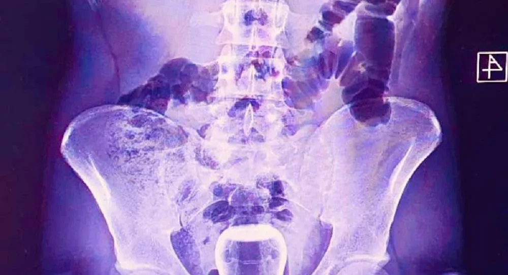 makat röntgeni kupa